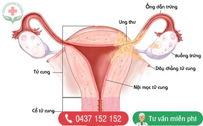 Dấu hiệu của u nang buồng trứng là gì?