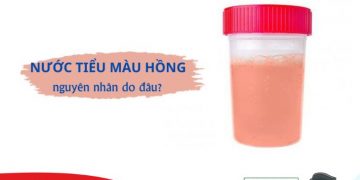 Nước tiểu có màu hồng: Nguyên nhân và cách xử lý